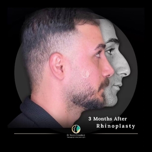 rhinoplasty-84