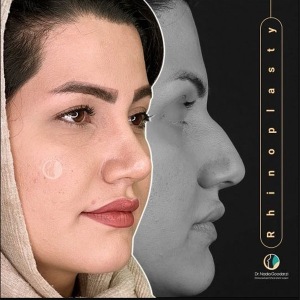 rhinoplasty-85