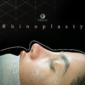 rhinoplasty-86