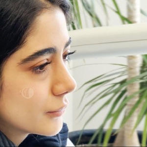 rhinoplasty-87