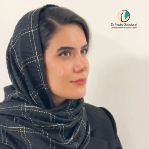 rhinoplasty-90