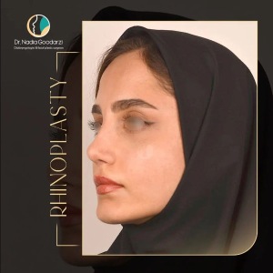 rhinoplasty-92