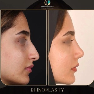 rhinoplasty-93