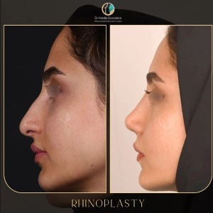 rhinoplasty-94