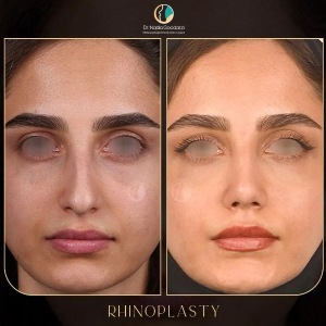 rhinoplasty-95