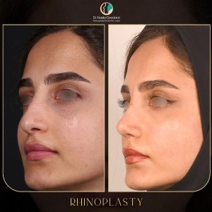 rhinoplasty-96