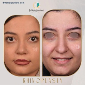 rhinoplasty-97