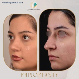 rhinoplasty-98