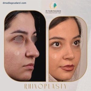 rhinoplasty-99