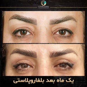 جراحی-پلک-4