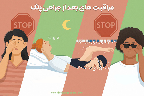 مراقبت های بعد از جراحی پلک - دکتر نادیا گودرزی
