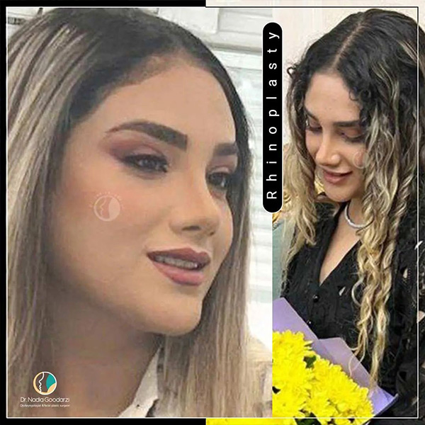 جراحی بینی فانتزی + دکتر نادیا گودرزی