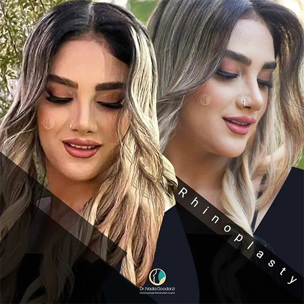 جراحی بینی فانتزی + دکتر نادیا گودرزی