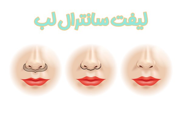 لیفت سانترال لب - دکتر گودرزی