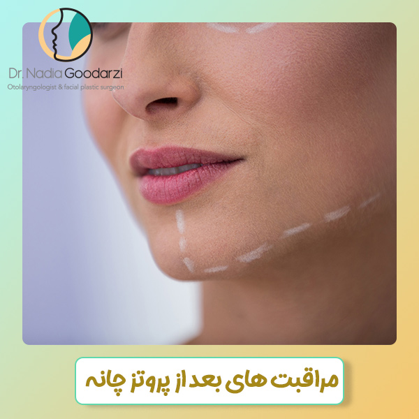 مراقبت های بعد از پروتز چانه - دکتر گودرزی