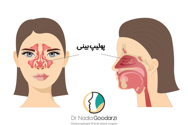 پولیپ بینی - دکتر نادیا گودرزی