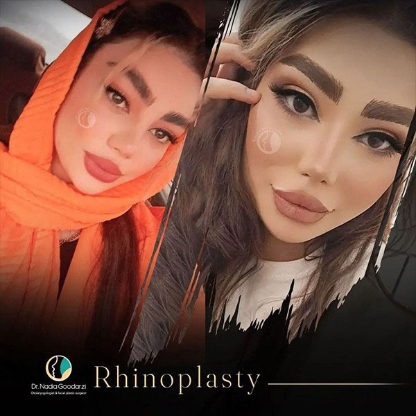 جراحی بینی کج - دکتر نادیا گودرزی