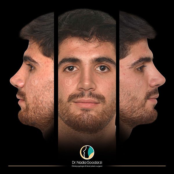 جراحی بینی طبیعی - دکتر نادیا گودرزی