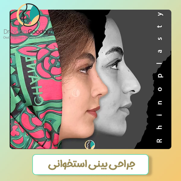 جراحی بینی استخوانی در تهران - دکتر نادیا گودرزی