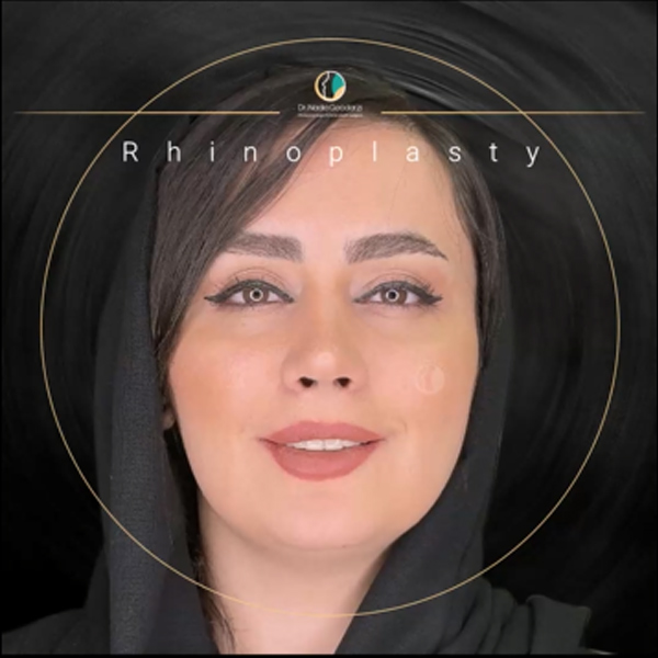 جراحی بینی نیمه فانتزی + دکتر نادیا گودرزی
