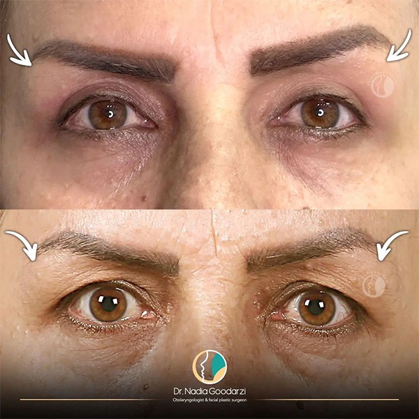 جراحی پلک - دکتر نادیا گودرزی