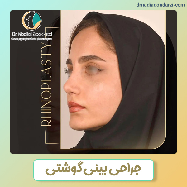 جراحی بینی گوشتی - دکتر نادیا گودرزی