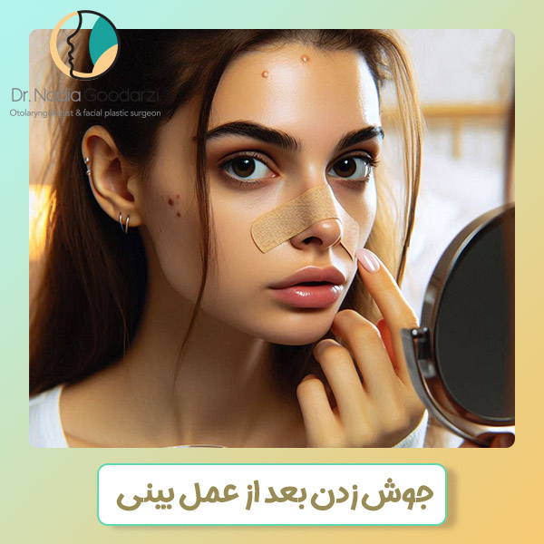 جوش زدن بعد از عمل بینی - دکتر نادیا گودرزی