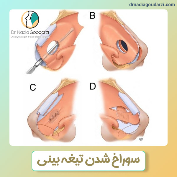 سوراخ شدن تیغه بینی + دکتر نادیا گودرزی