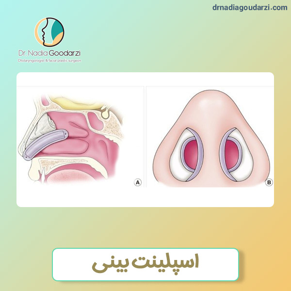 اسپلینت بینی - دکتر نادیا گودرزی