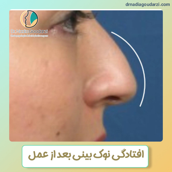 افتادگی نوک بینی بعد از جراحی - دکتر نادیا گودرزی