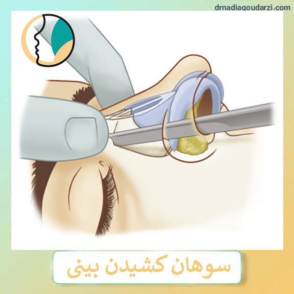 رسپینگ بینی _ دکتر نادیا گودرزی