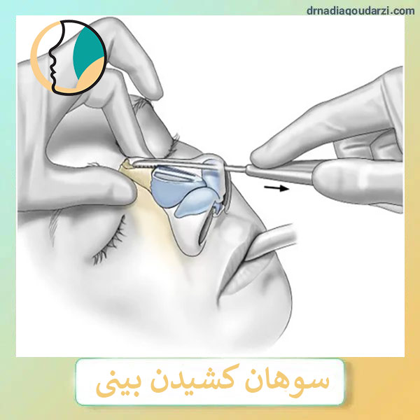 رسپینگ بینی _ دکتر نادیا گودرزی