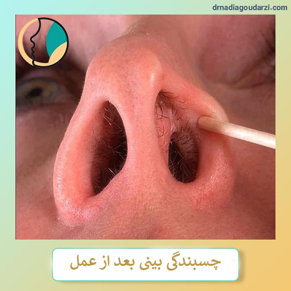 چسبندگی بینی بعد از عمل _ دکتر نادیا گودرزی