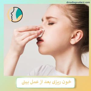 خون ریزی بعد از عمل بینی - دکتر نادیا گودرزی