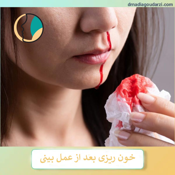 خون ریزی بعد از جراحی بینی - دکتر نادیا گودرزی