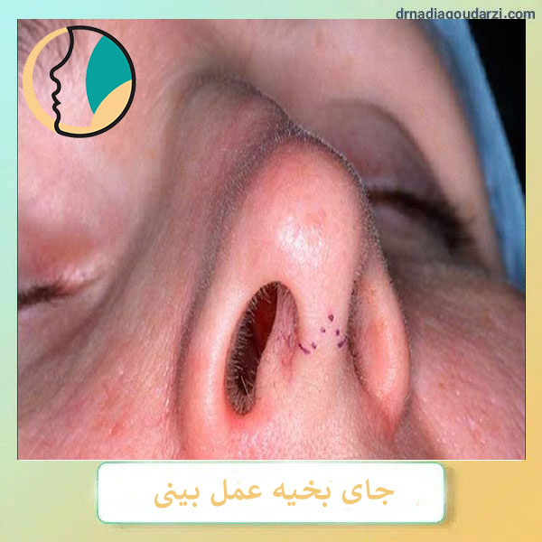 جای بخیه عمل بینی _ دکتر نادیا گودرزی