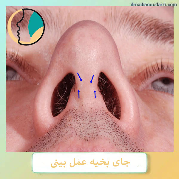 جای بخیه عمل بینی _ دکتر نادیا گودرزی