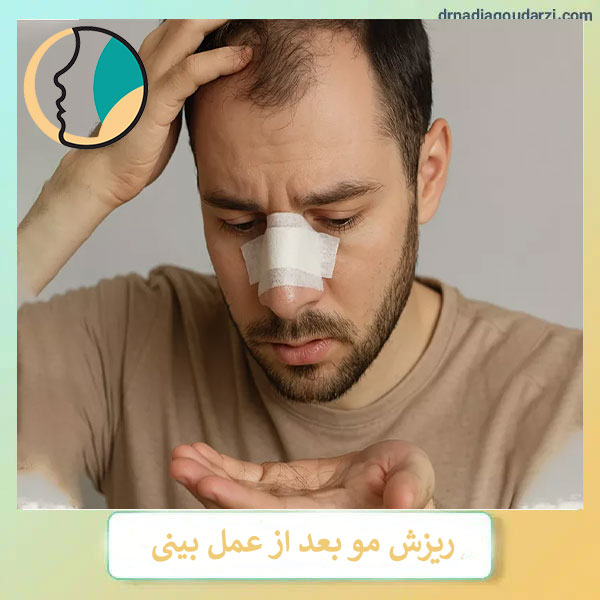 ریزش موبعد از رینوپللاستی _ دکتر نادیا گودرزی