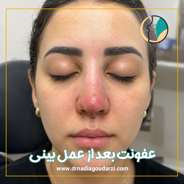 عفونت بعد از عمل بینی + دکتر نادیا گودرزی